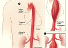 Aortic Aneurysm