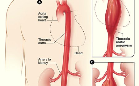 Aortic Aneurysm