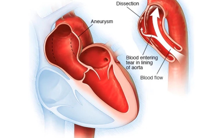Aortic Dissection